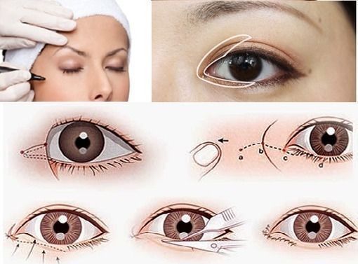 Chuẩn mực đôi mắt đẹp và các phương pháp phẫu thuật thẩm mỹ mắt