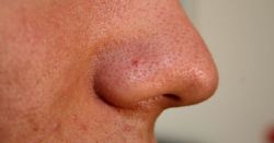 Trắc nghiệm da: Bạn đã thực sự hiểu rõ về mụn?