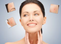 Trị mụn như thế nào là đúng cách?
