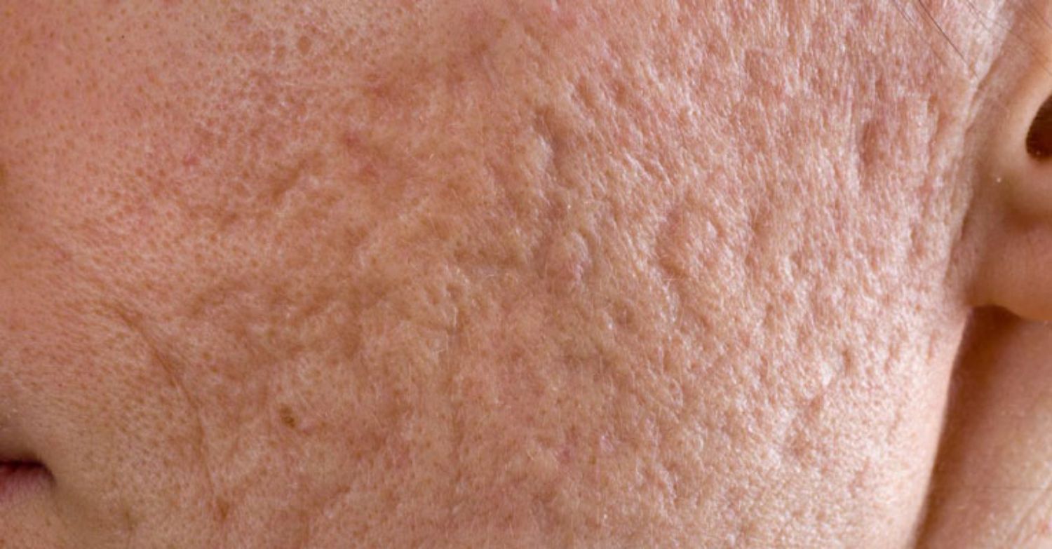 Trị sẹo do mụn bằng tế bào gốc