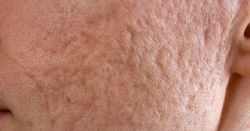 Trị sẹo do mụn bằng tế bào gốc