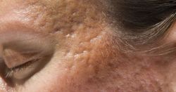 Cách trị sẹo mụn bằng tiêm các chất làm đầy