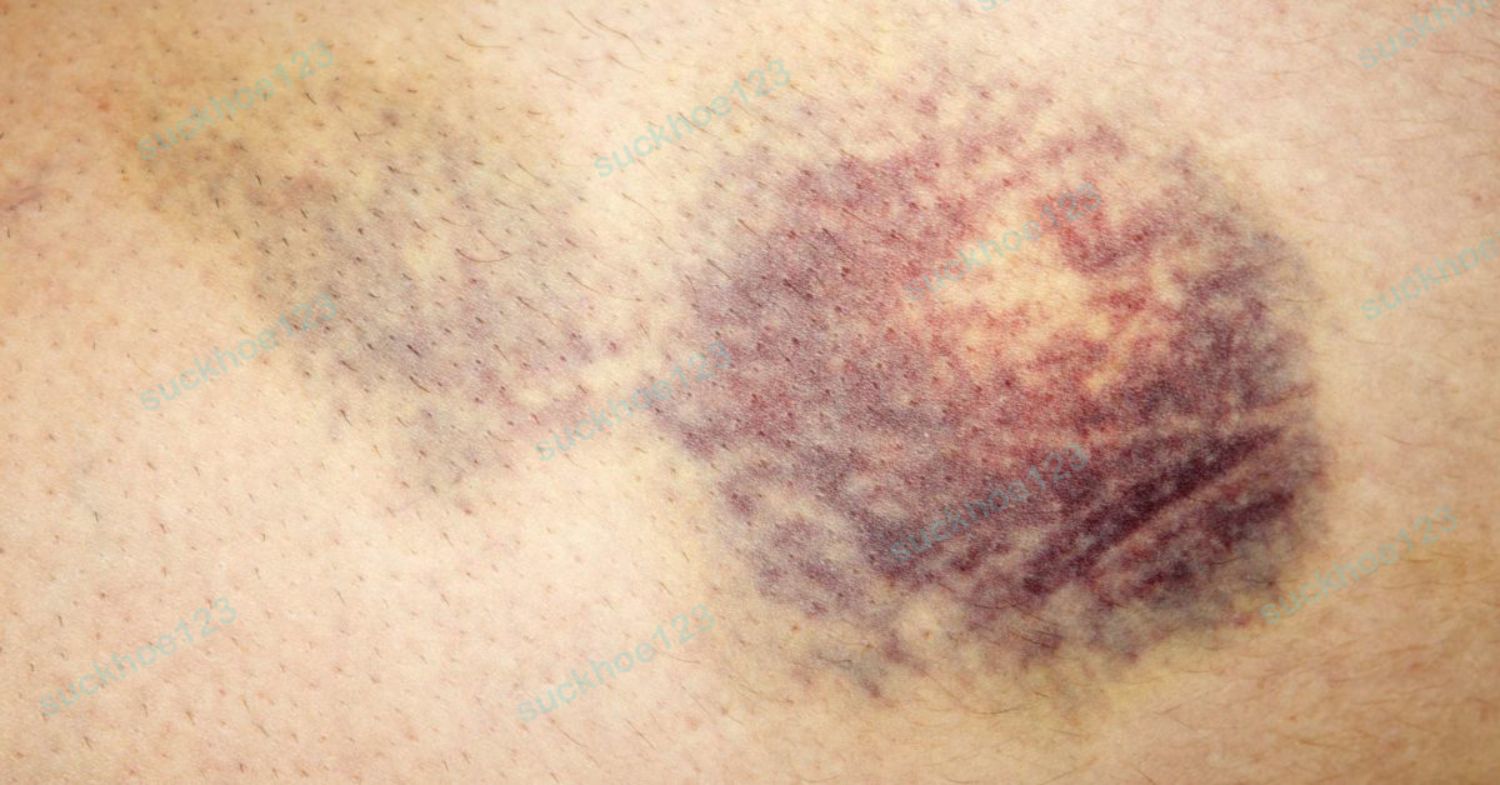 Tụ máu sau tạo hình thành bụng