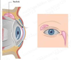 Tổn thương tuyến lệ sau phẫu thuật cắt mí