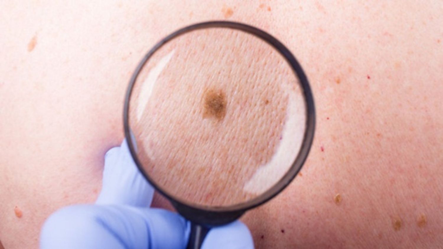 Có những loại ung thư da nào?