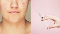 Sắp có vắc-xin ngừa mụn trứng cá