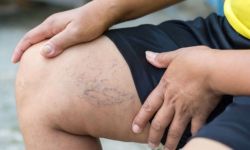 Những dấu hiệu cho thấy bệnh tĩnh mạch đã trở nên nghiêm trọng