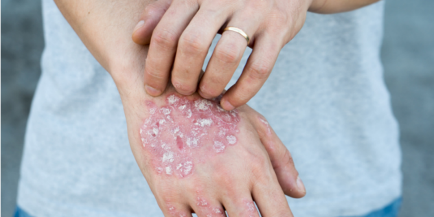 Bệnh vảy nến cần chăm sóc da như thế nào?