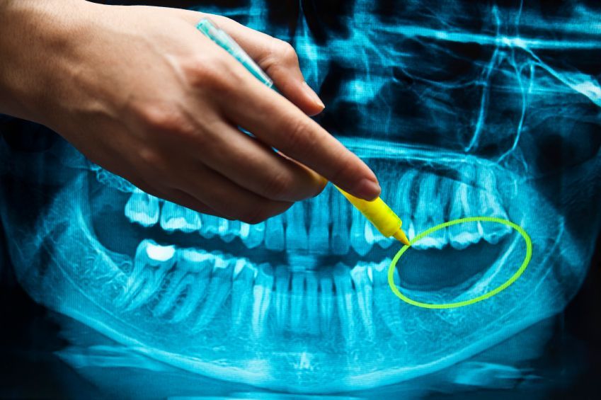 Tại sao cần chụp X-quang khi niềng răng?