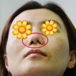 Khắc phục mũi bị nghiêng bên trái sau khi nâng