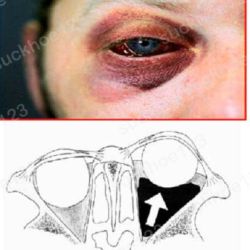 Xuất huyết hốc mắt sau phẫu thuật mí mắt