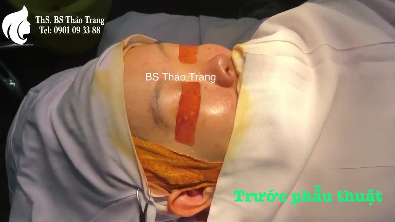 Nâng mũi cấu trúc sụn sườn tự thân