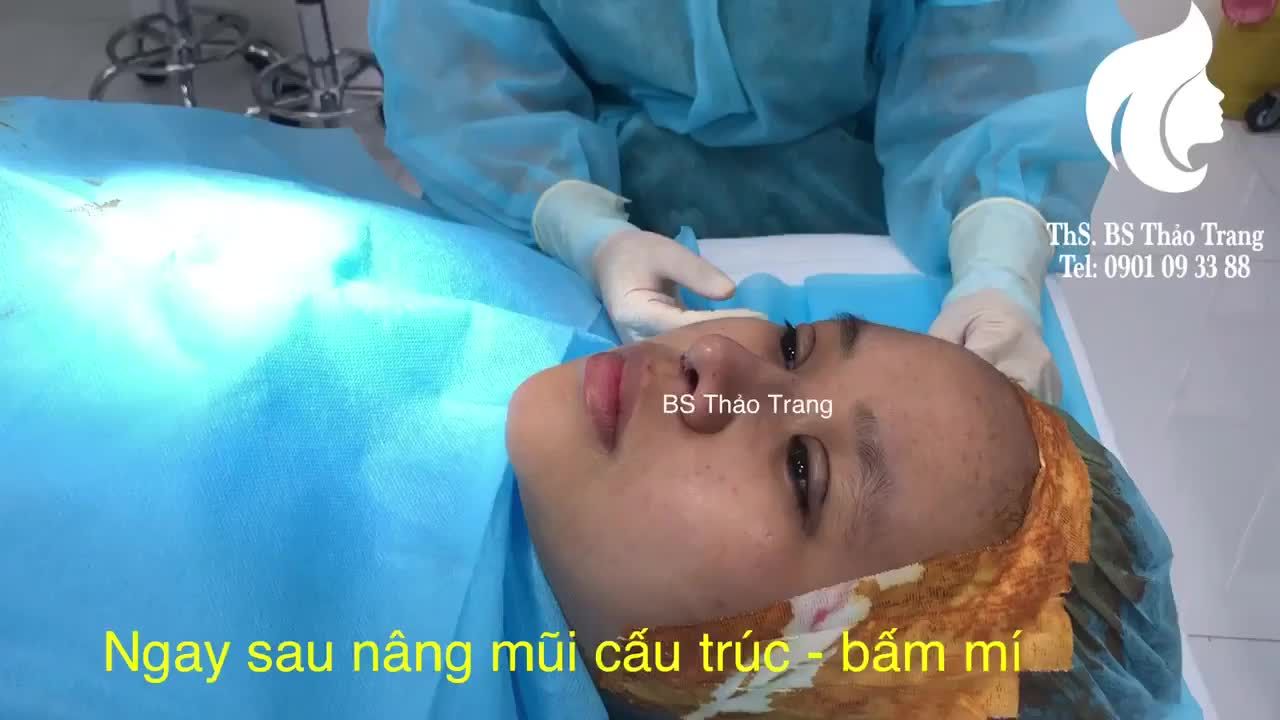 Nâng mũi cấu trúc và bấm mí