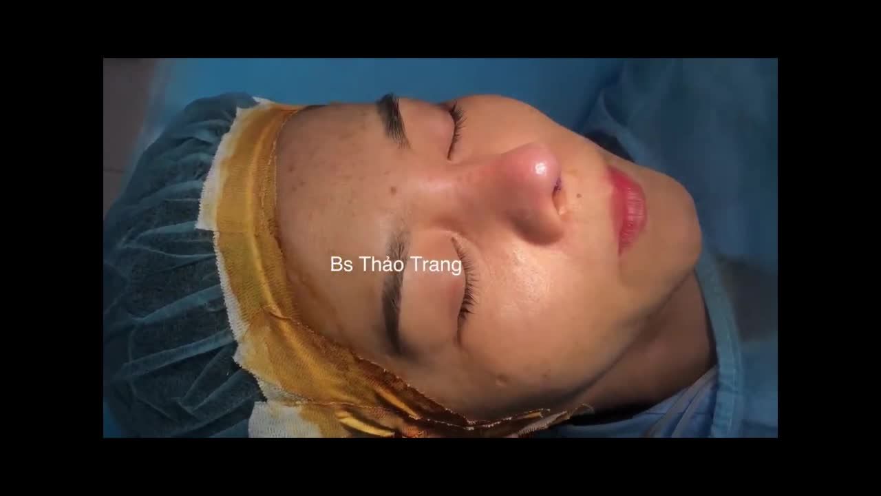 Chỉnh sửa mũi hỏng