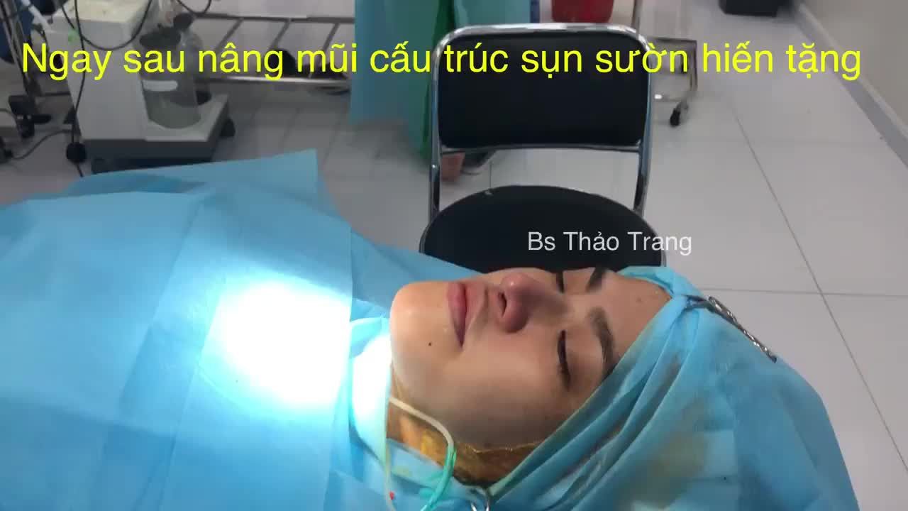 Nâng mũi cấu trúc sụn sườn hiến tặng