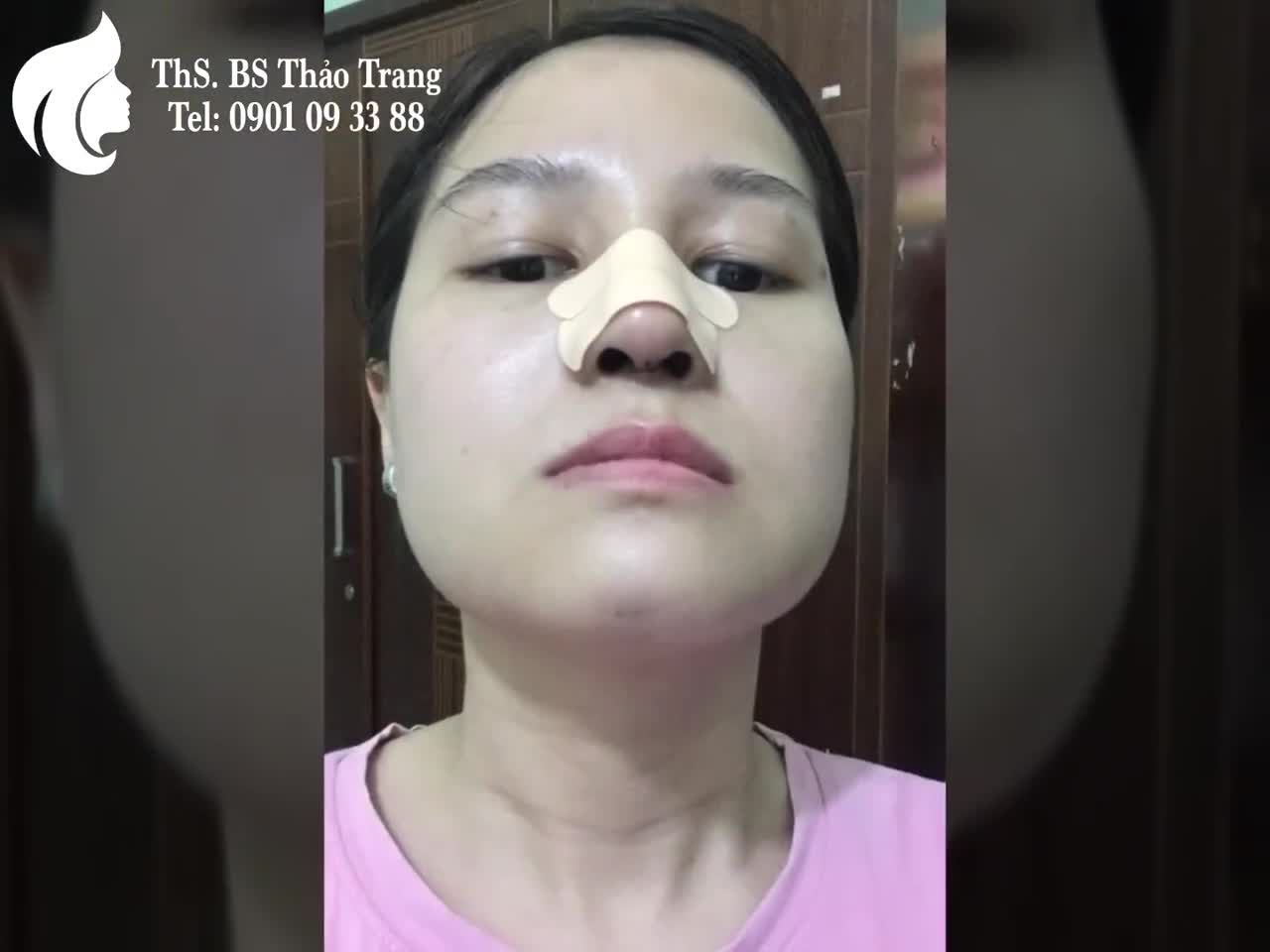 Hành trình 1 chiếc mũi 6 tháng