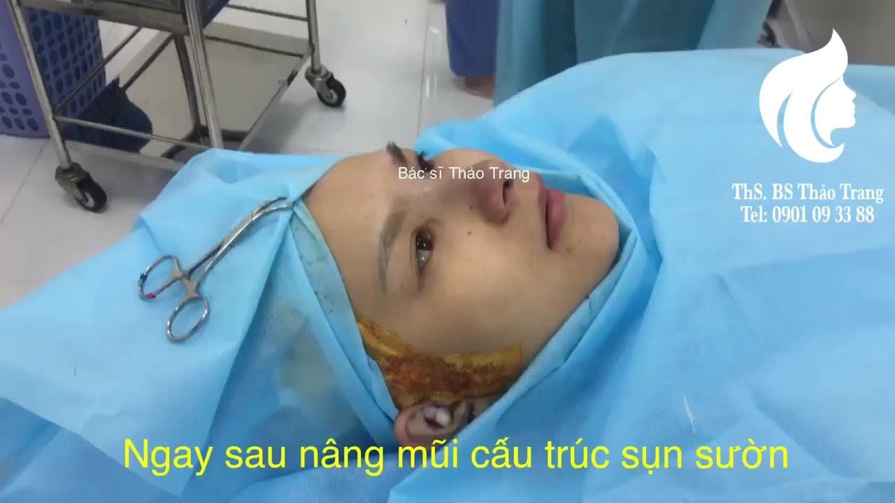 Nâng mũi cấu trúc sụn sườn