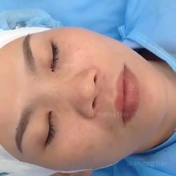 Phân tích trước phẫu thuật nâng mũi cấu trúc cho bạn gái đến từ Long An