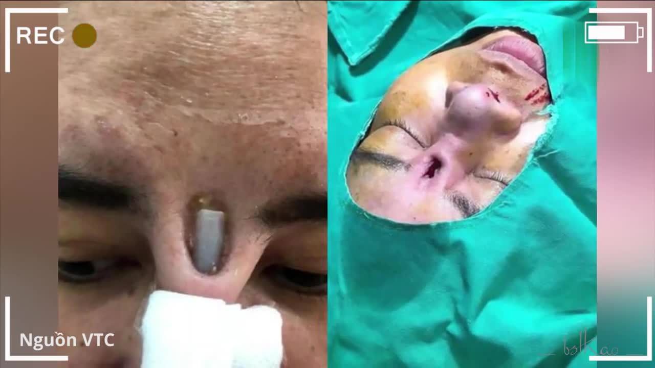 Nâng mũi bị lỗi và giải pháp