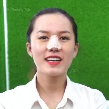 Câu chuyện nâng mũi của bạn Thương (p.6)