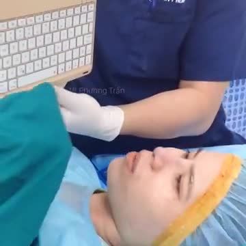 Nâng mũi cấu trúc sụn sườn cho KH đến từ Bình Thuận (p2-kết quả)