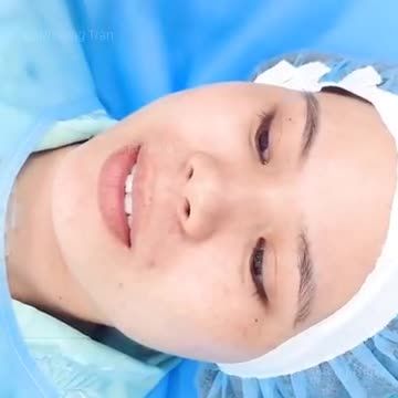 Nâng mũi cấu trúc sụn sườn cho KH đến từ Bình Thuận (p1-chuẩn bị)