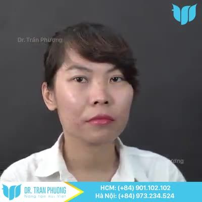 Cùng bs Trần Phương xem dáng mũi ngay sau khi nâng