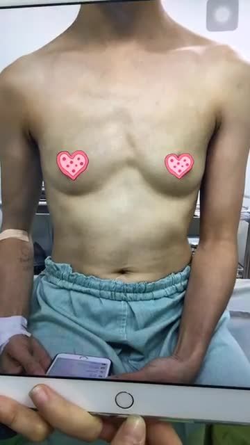 Nâng ngực túi độn size 300 cc