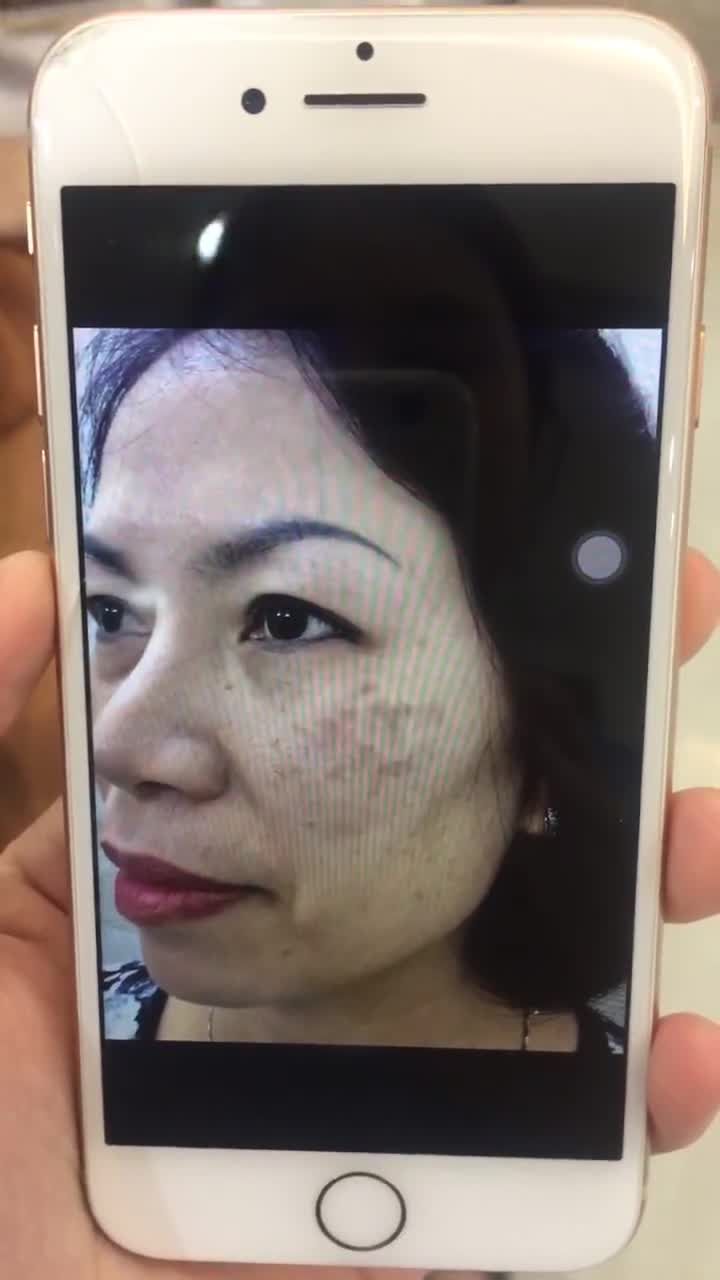 Kết  quả trị nám mỹ mãn