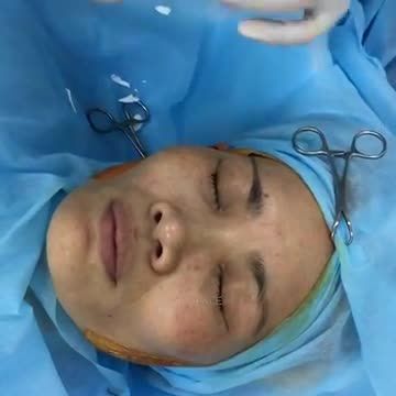 Cas nâng mũi cuối ngày, cuối tuần (p1- chuẩn bị)