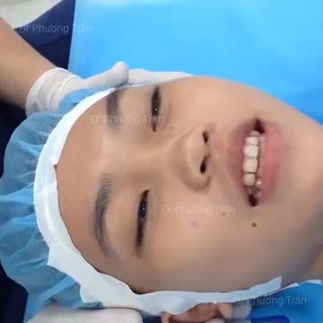 Nâng mũi cho 1 bạn gái đến từ trường Luật (p1-chuẩn bị)