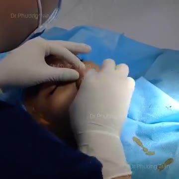 Nâng mũi cho 1 bạn gái đến từ trường Luật (p2-kết quả)