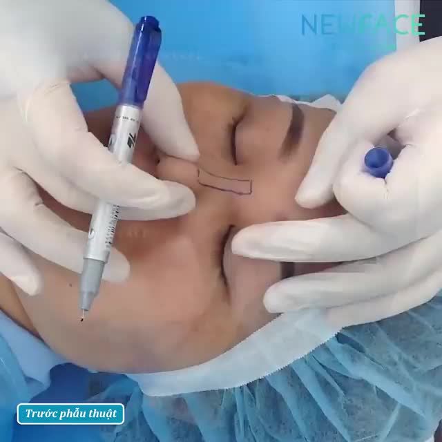 Nâng mũi sống mũi gãy