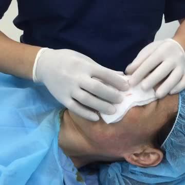 Cas nâng mũi cuối ngày, cuối tuần (p2 - kết quả)