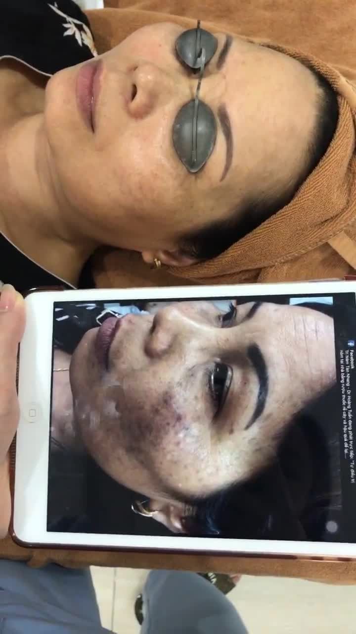 KH tự điều trị nám tại nhà để rồi...