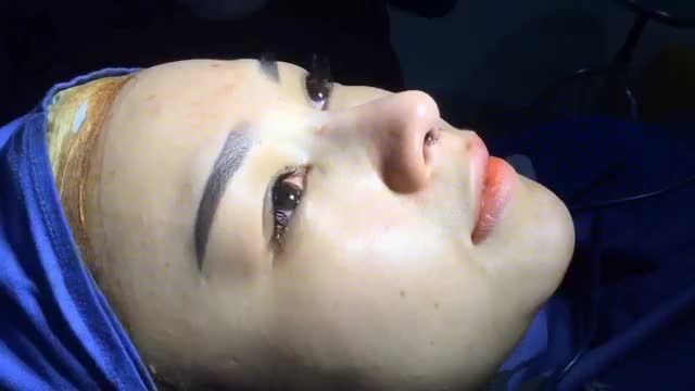 "Biến hình" chỉ sau 60 phút nâng mũi cấu trúc