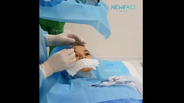 Theo dõi bác sĩ Trần Phương thực hiện cắt mí miniplasty