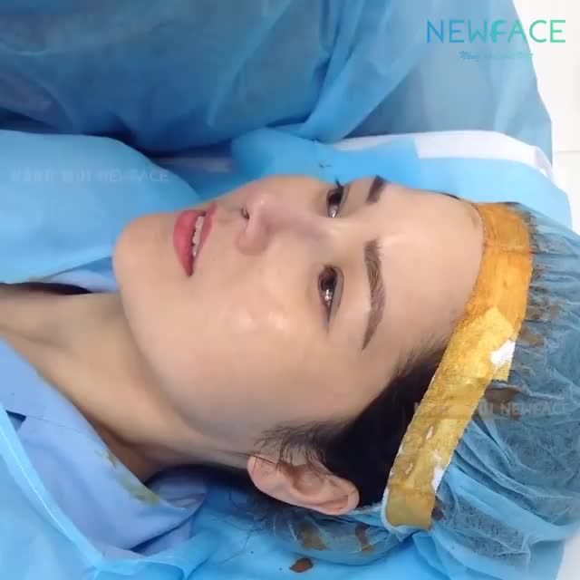 Đẹp ngỡ ngàng với kết quả nâng mũi cấu trúc