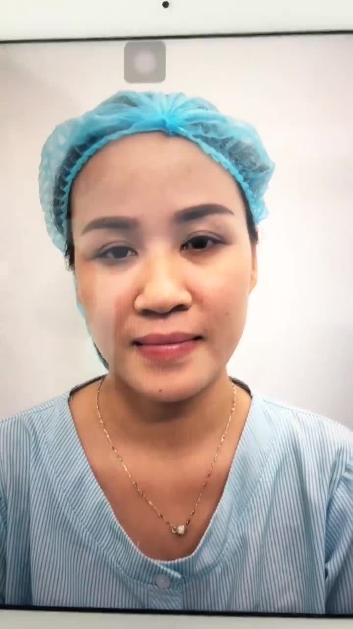 Tạo hình mũi SOFTLINE