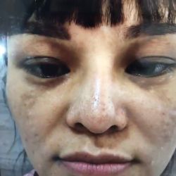 Điều trị nám mảng tại TMV Hoàng Tuấn