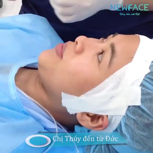 Sự thay đổi khác biệt sau nâng mũi