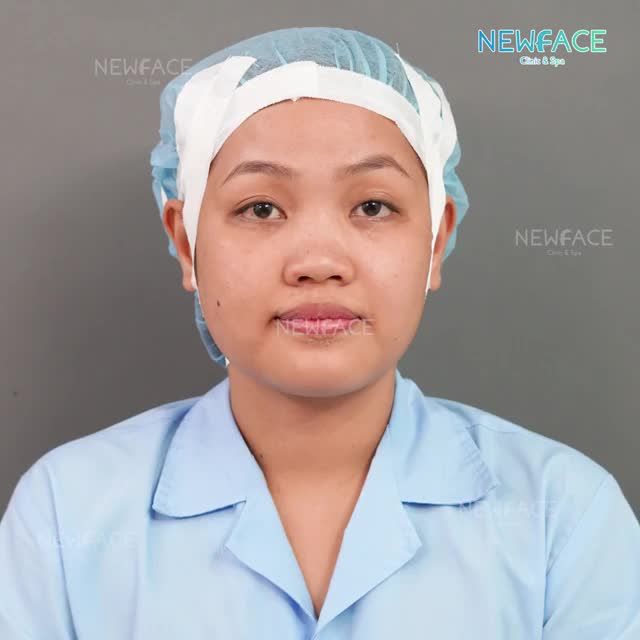 Nâng mũi có kèm phủ mô da nhân tạo