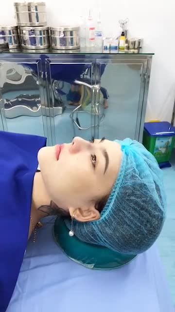 Nâng mũi Softline trên KH đã từng tiêm filler mũi