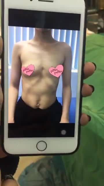 Nâng ngực túi độn size 320 cc