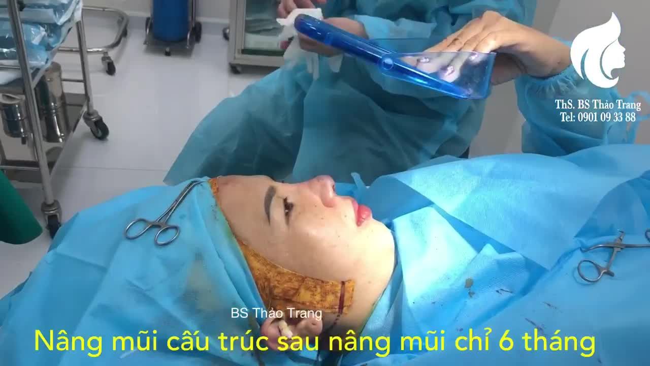 Nâng mũi cấu trúc sau nâng mũi chỉ 6 tháng