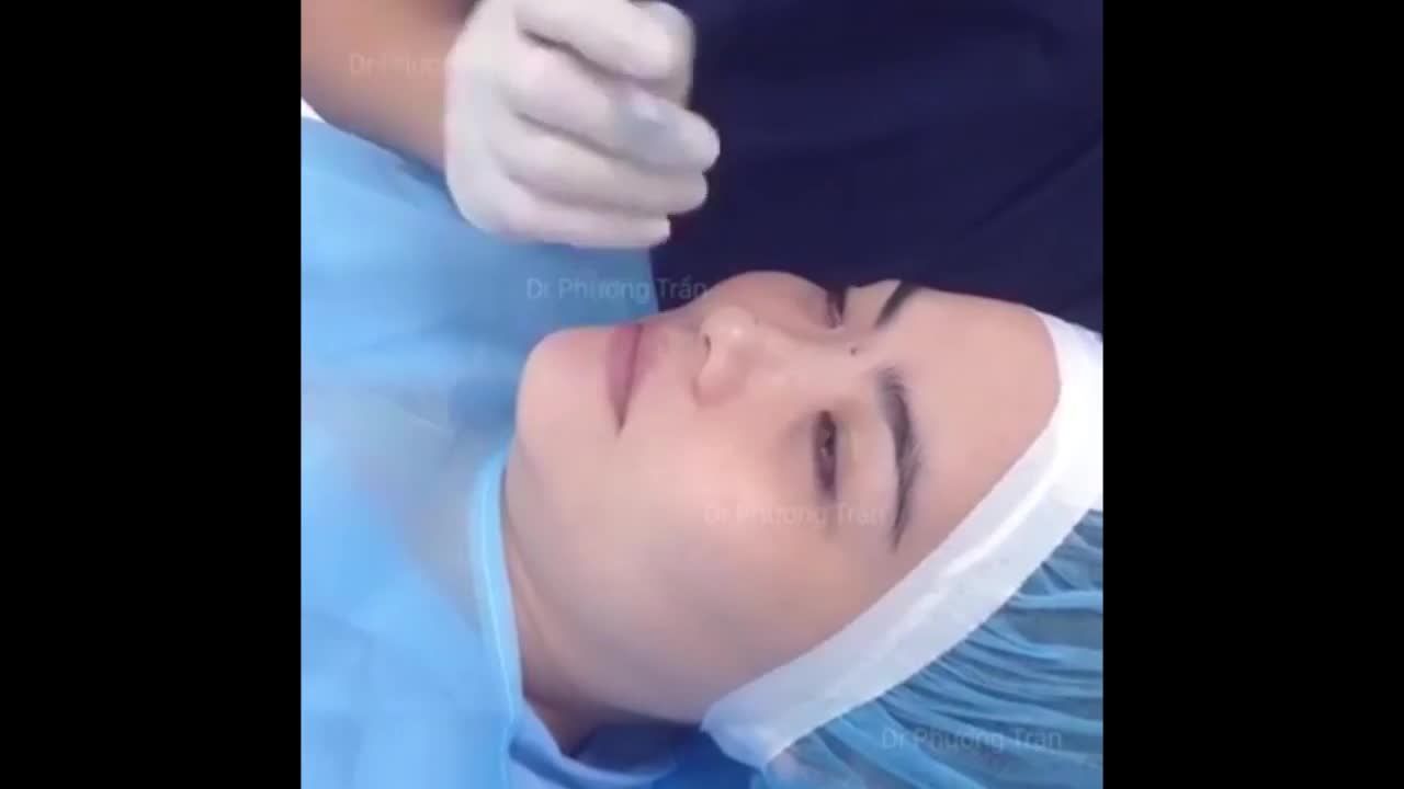 Nâng mũi cấu trúc