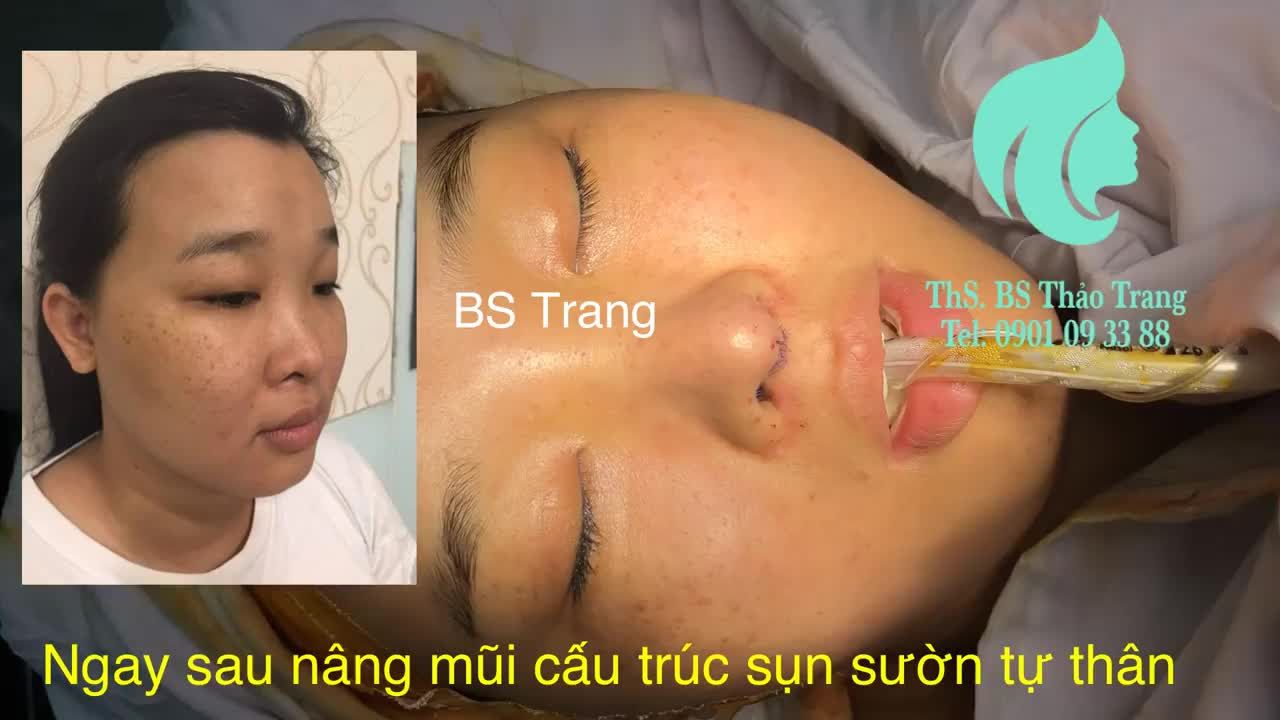 Ngay sau nâng mũi cấu trúc sụn sườn tự thân