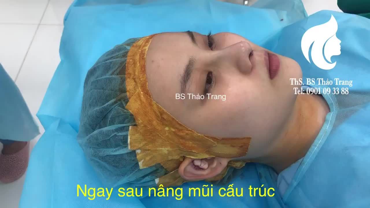 Ngay sau khi nâng mũi cấu trúc sụn sườn
