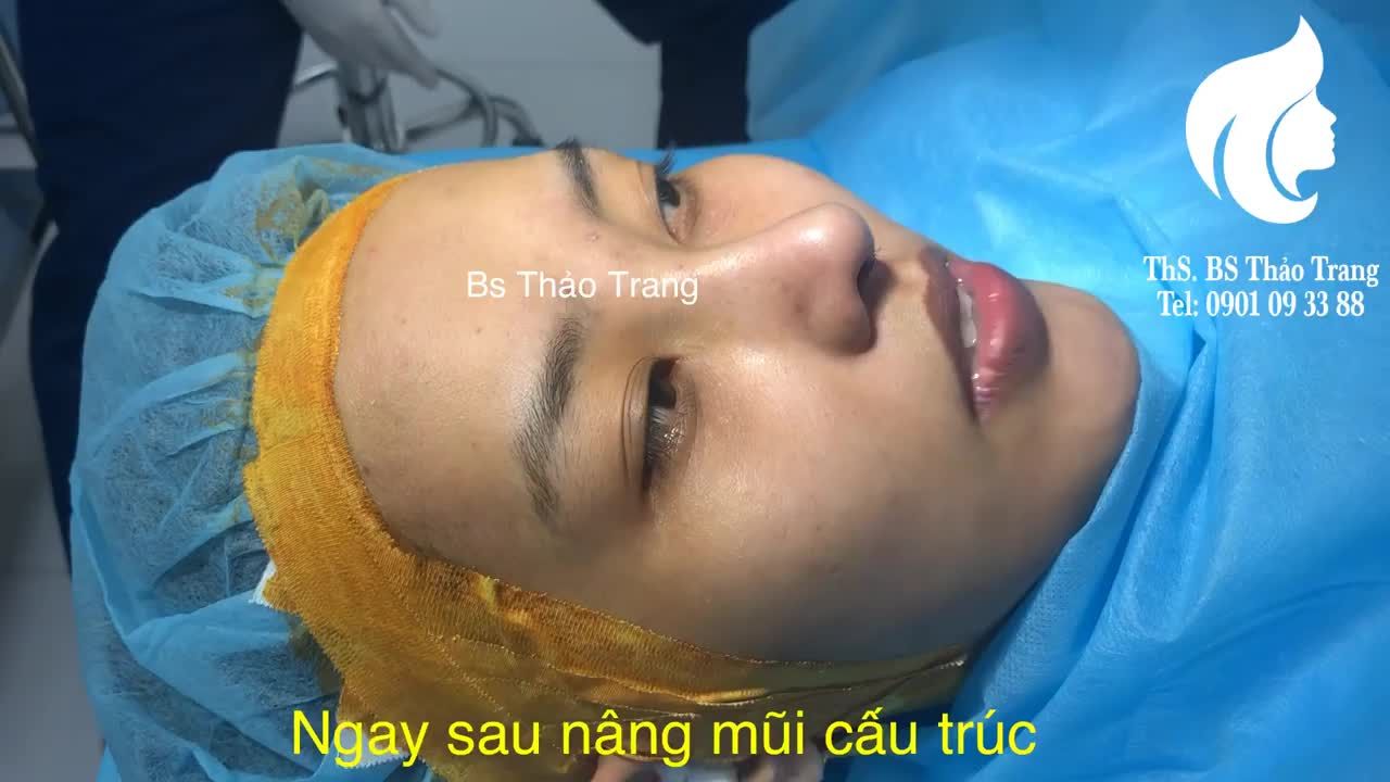 Kết quả nâng mũi cấu trúc sau 90' thực hiện