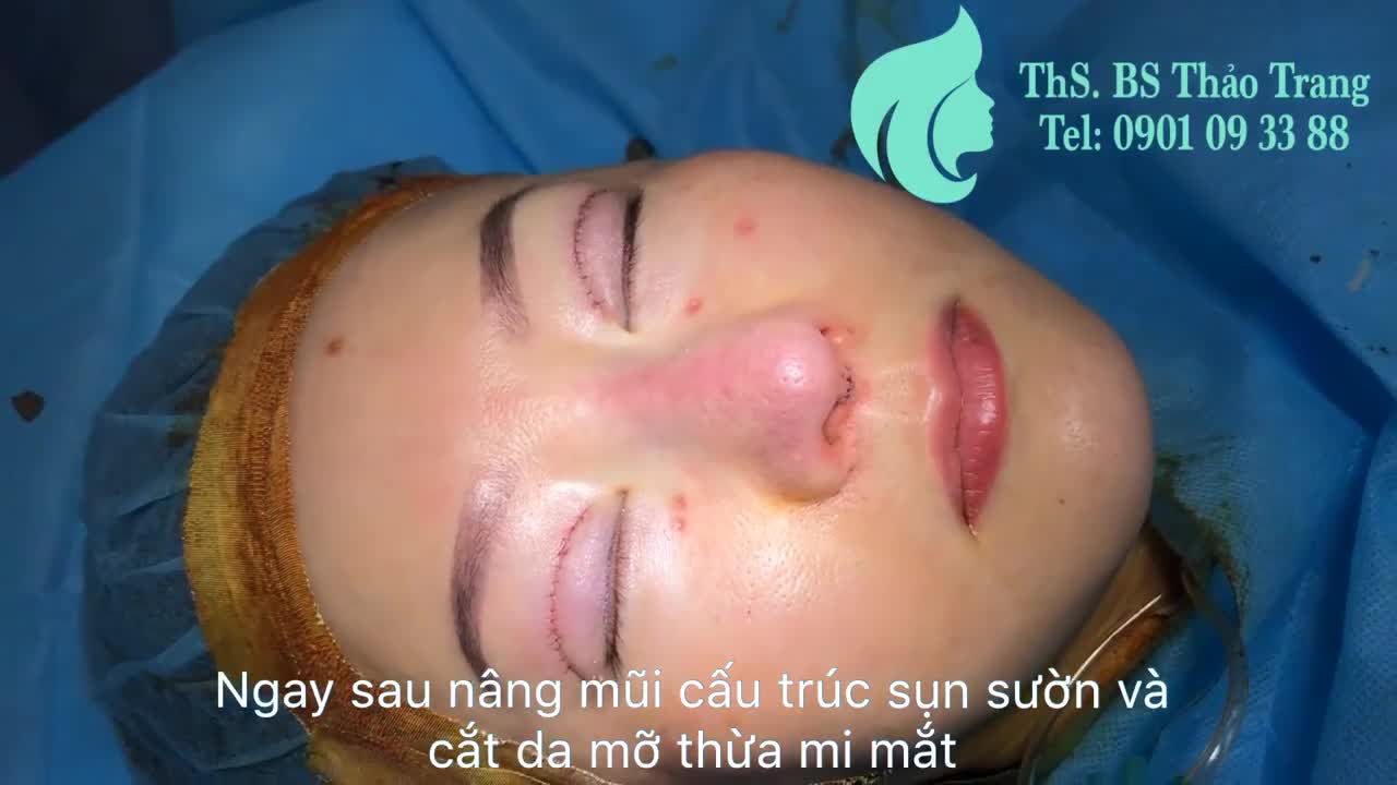 Nâng mũi cấu trúc sụn sườn và cắt da thừa mí mắt